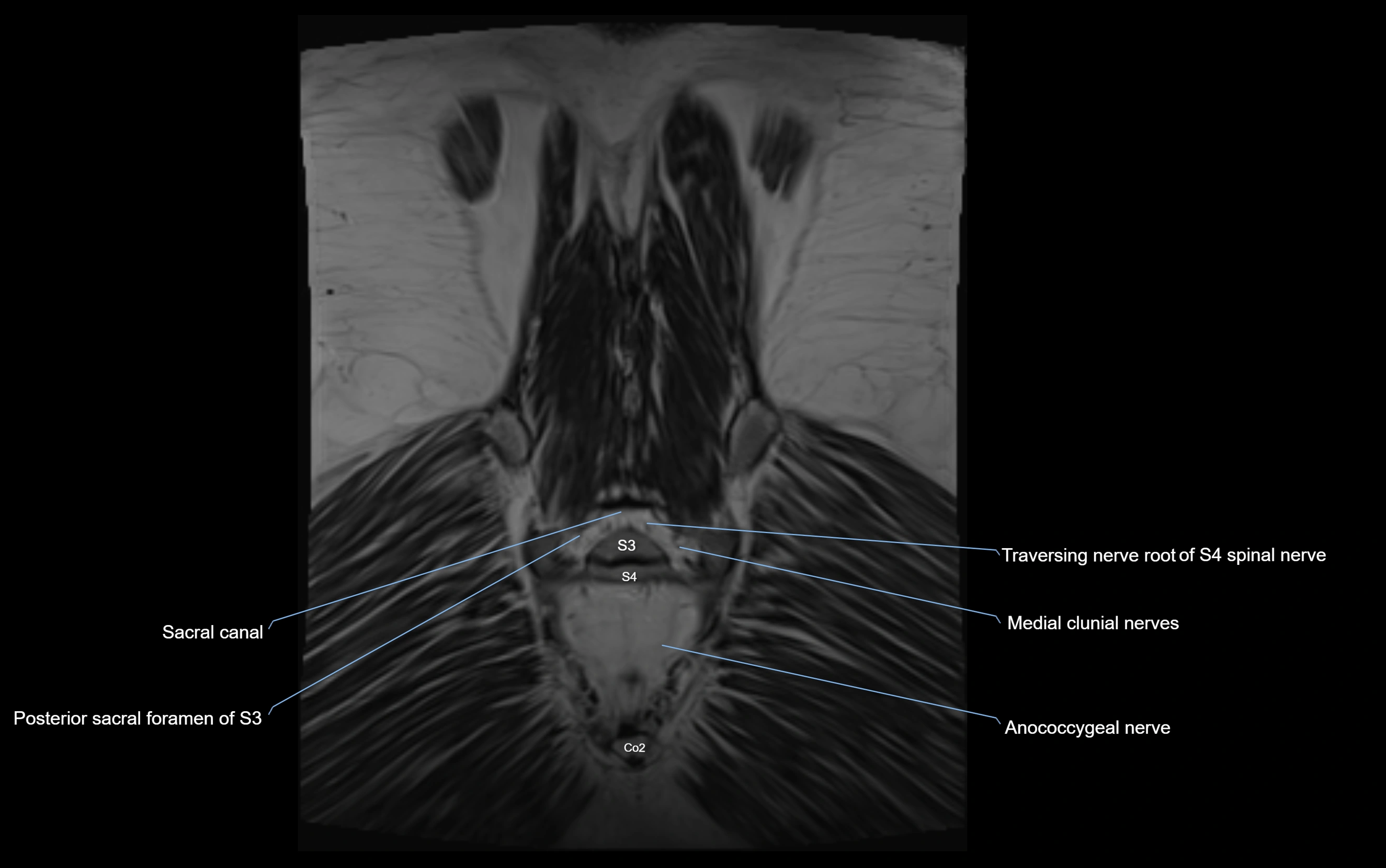 MR lumbosacral plexus cross sectional anatomy 3T  radiology  image-img-09001-00077.webp